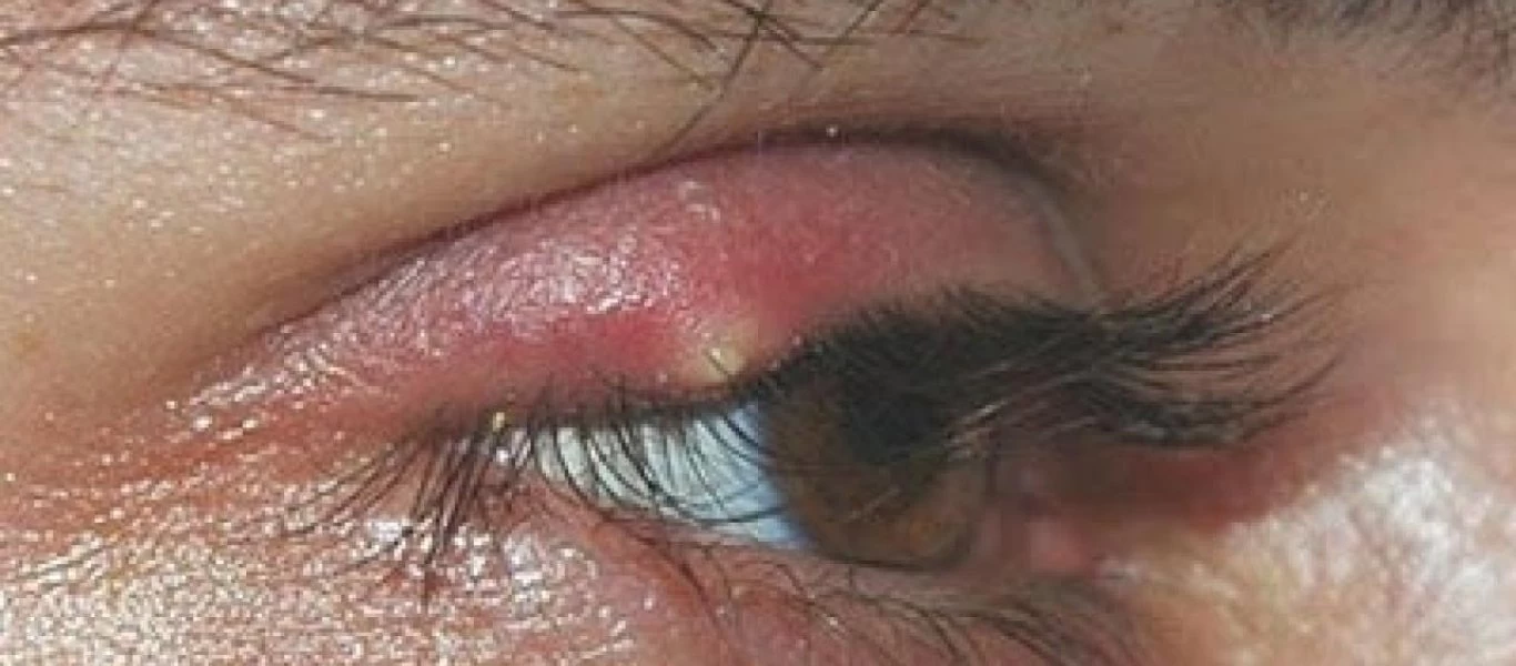 Κριθαράκι στο μάτι: 3+1 φυσικοί τρόποι για να του πείτε άμεσα «αντίο»